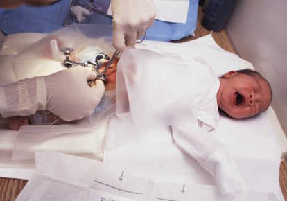 Une circoncision en milieu hospitalier, pratiquée sur un bébé âgée de 3 jours - © 2009 Jonathan Hill - Agence: iStockPhoto.